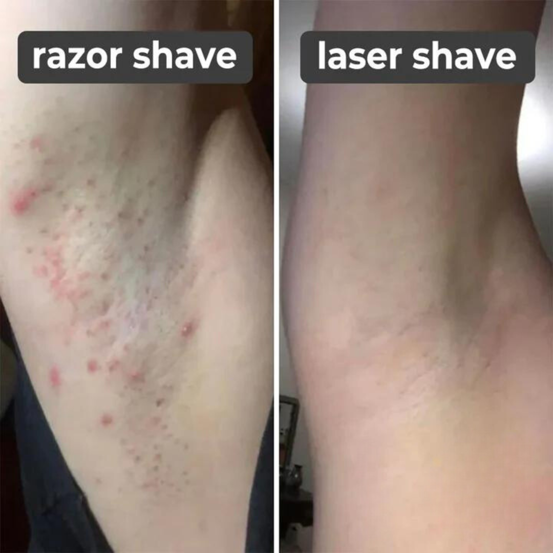 Last Day 50% OFF I  Laser Hair Remover